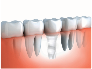 Zirconia Dental Implant